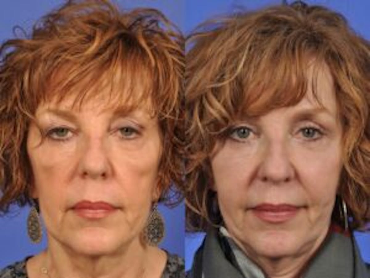 Eyelid Revision Surgery Before & After Gallery - Patient 303792 - Image 1