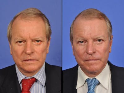 Eyelid Revision Surgery Before & After Gallery - Patient 183169 - Image 1