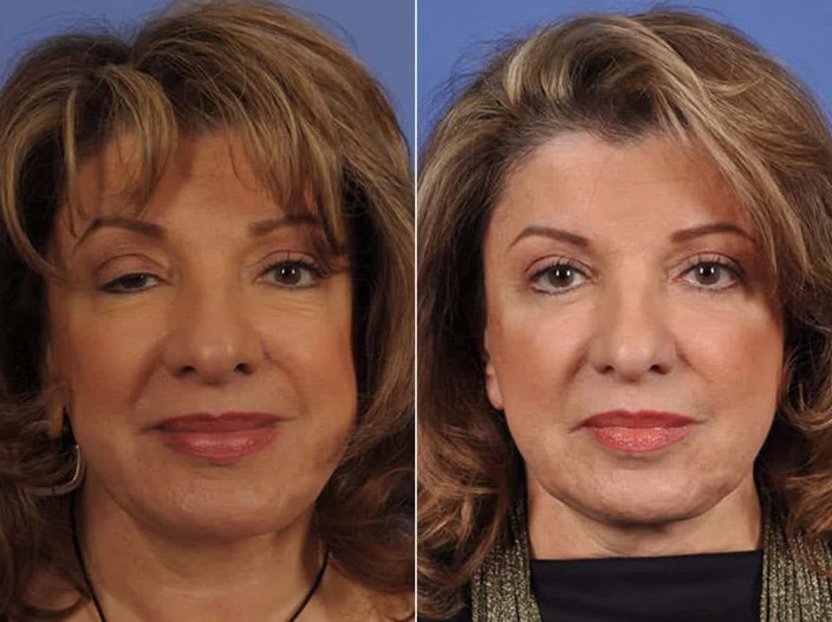 Eyelid Revision Surgery Before & After Gallery - Patient 316185 - Image 1
