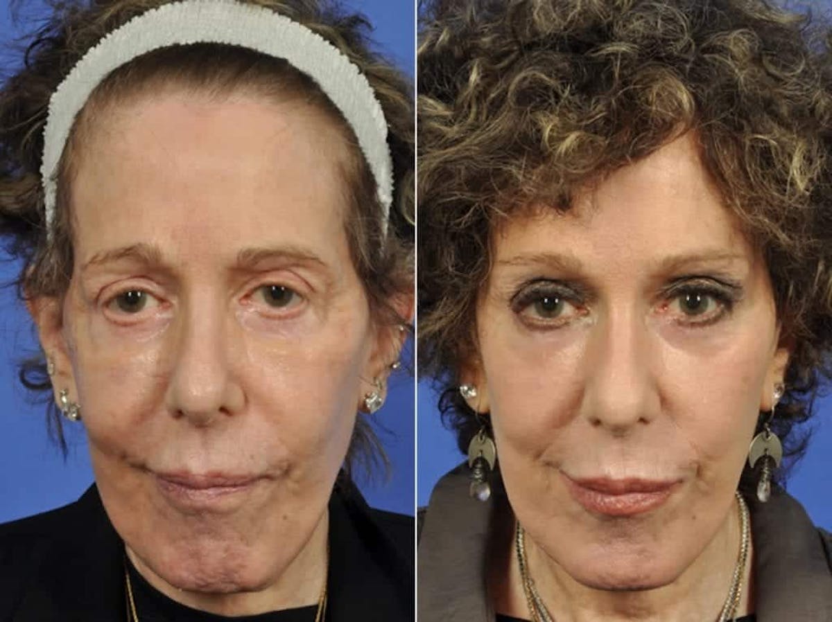Eyelid Revision Surgery Before & After Gallery - Patient 263833 - Image 1