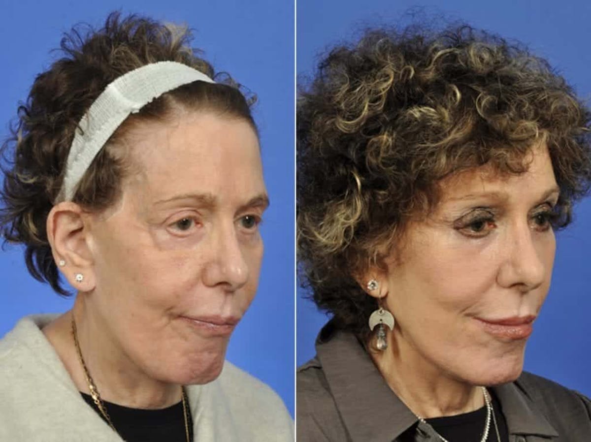Eyelid Revision Surgery Before & After Gallery - Patient 263833 - Image 2