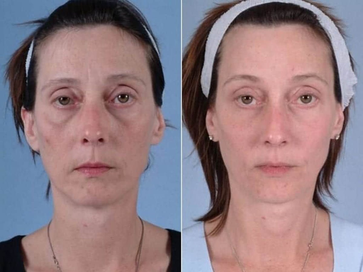 Eyelid Revision Surgery Before & After Gallery - Patient 391706 - Image 1