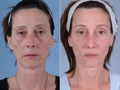 Eyelid Revision Surgery Before & After Gallery - Patient 391706 - Image 1