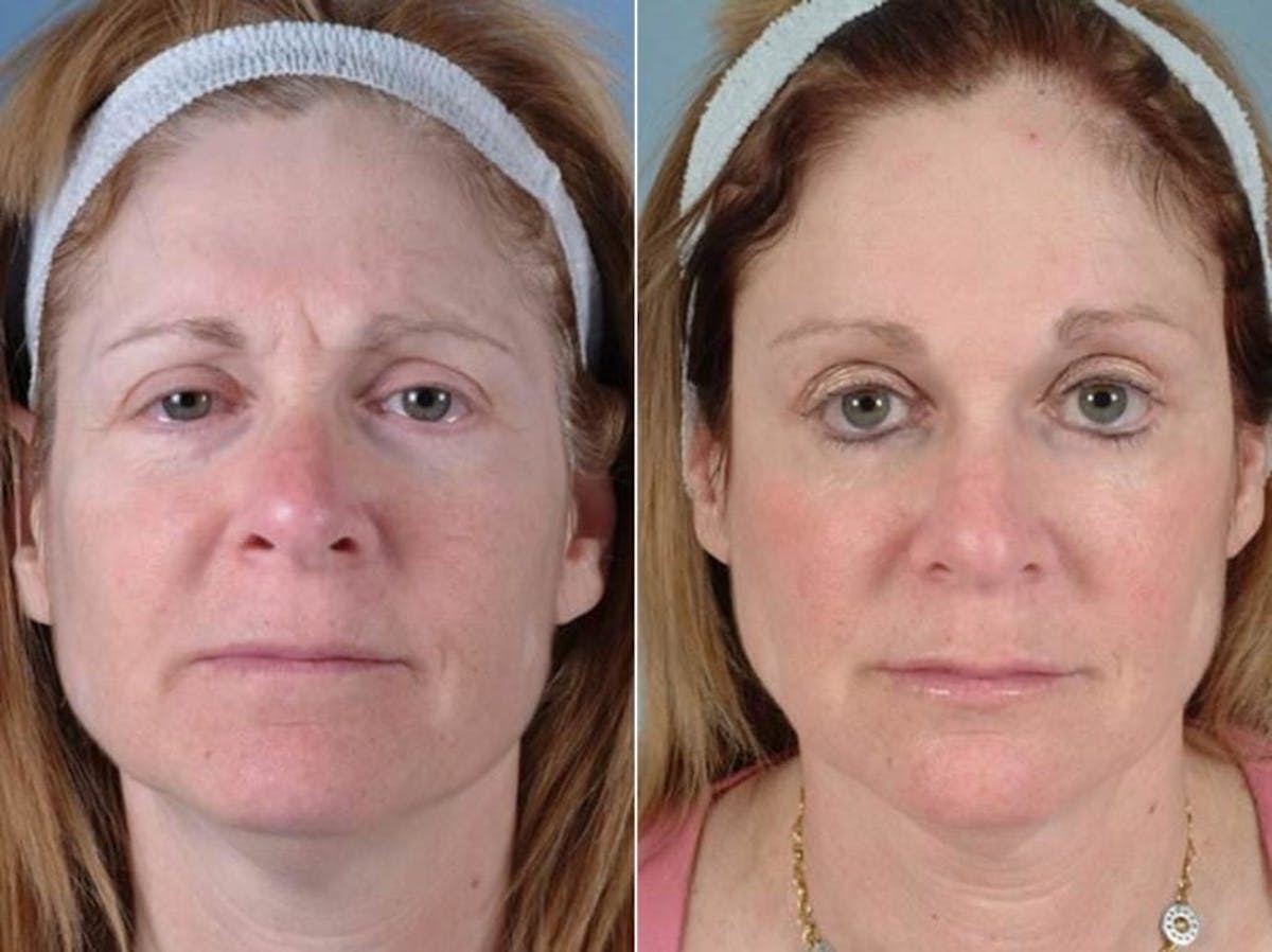 Eyelid Revision Surgery Before & After Gallery - Patient 352175 - Image 1