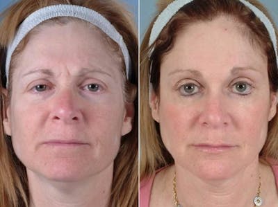 Eyelid Revision Surgery Before & After Gallery - Patient 352175 - Image 1