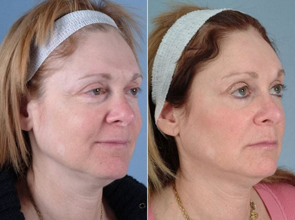 Eyelid Revision Surgery Before & After Gallery - Patient 352175 - Image 2