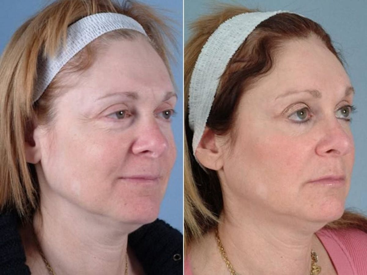 Eyelid Revision Surgery Before & After Gallery - Patient 352175 - Image 2