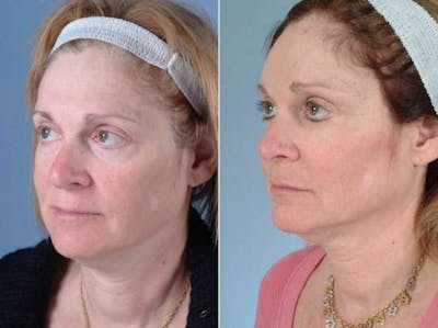 Eyelid Revision Surgery Before & After Gallery - Patient 352175 - Image 3