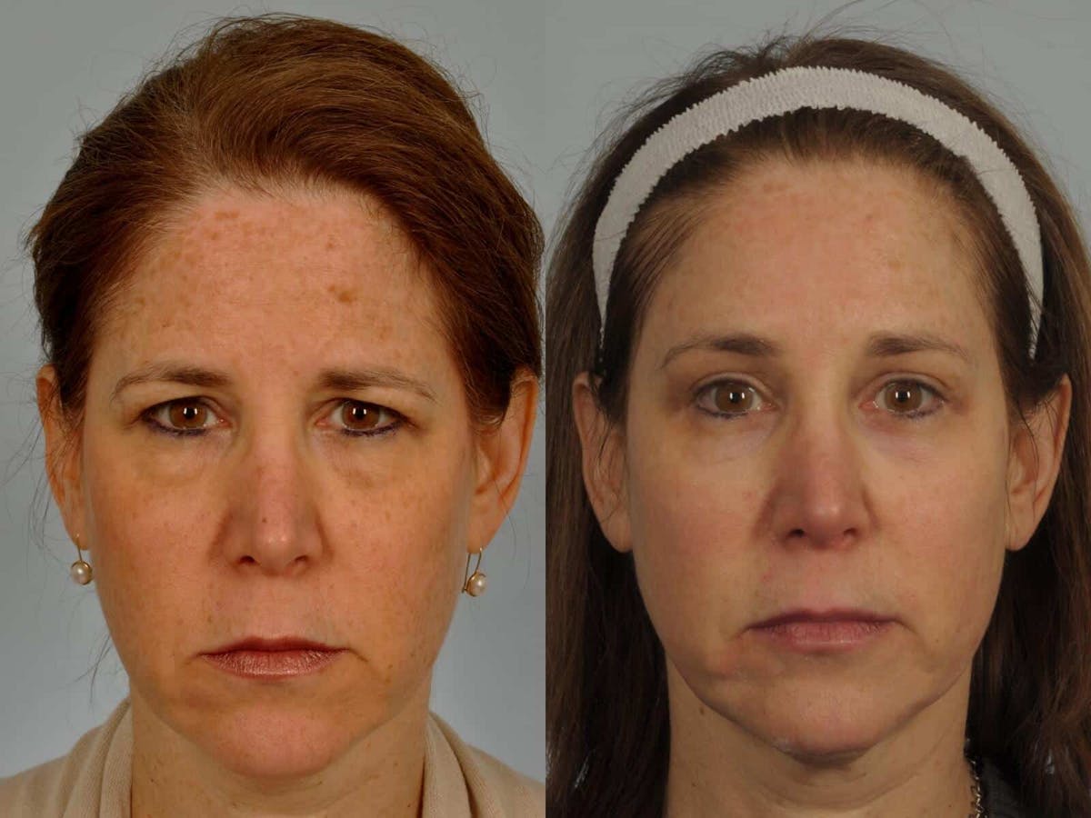 Brow Lift Before & After Gallery - Patient 413242 - Image 1