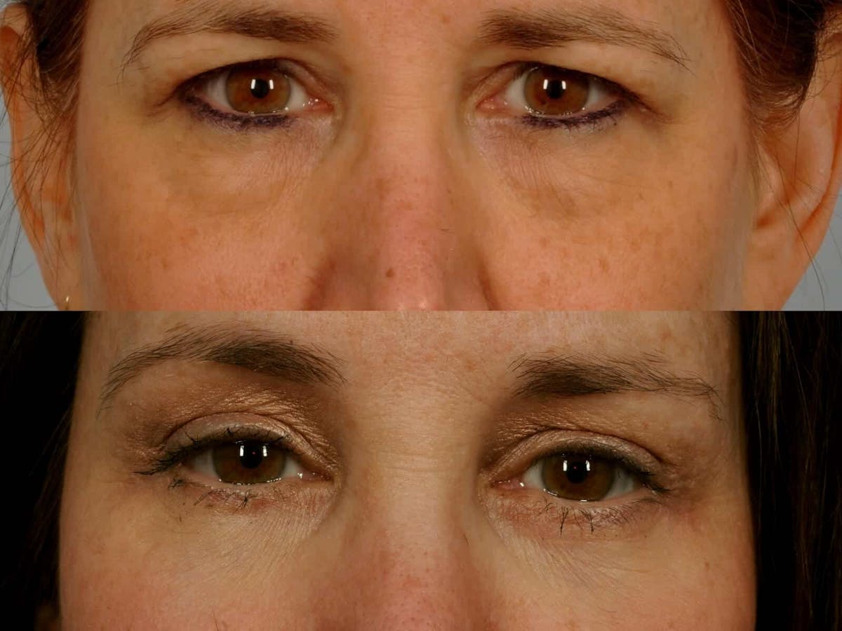 Brow Lift Before & After Gallery - Patient 413242 - Image 2