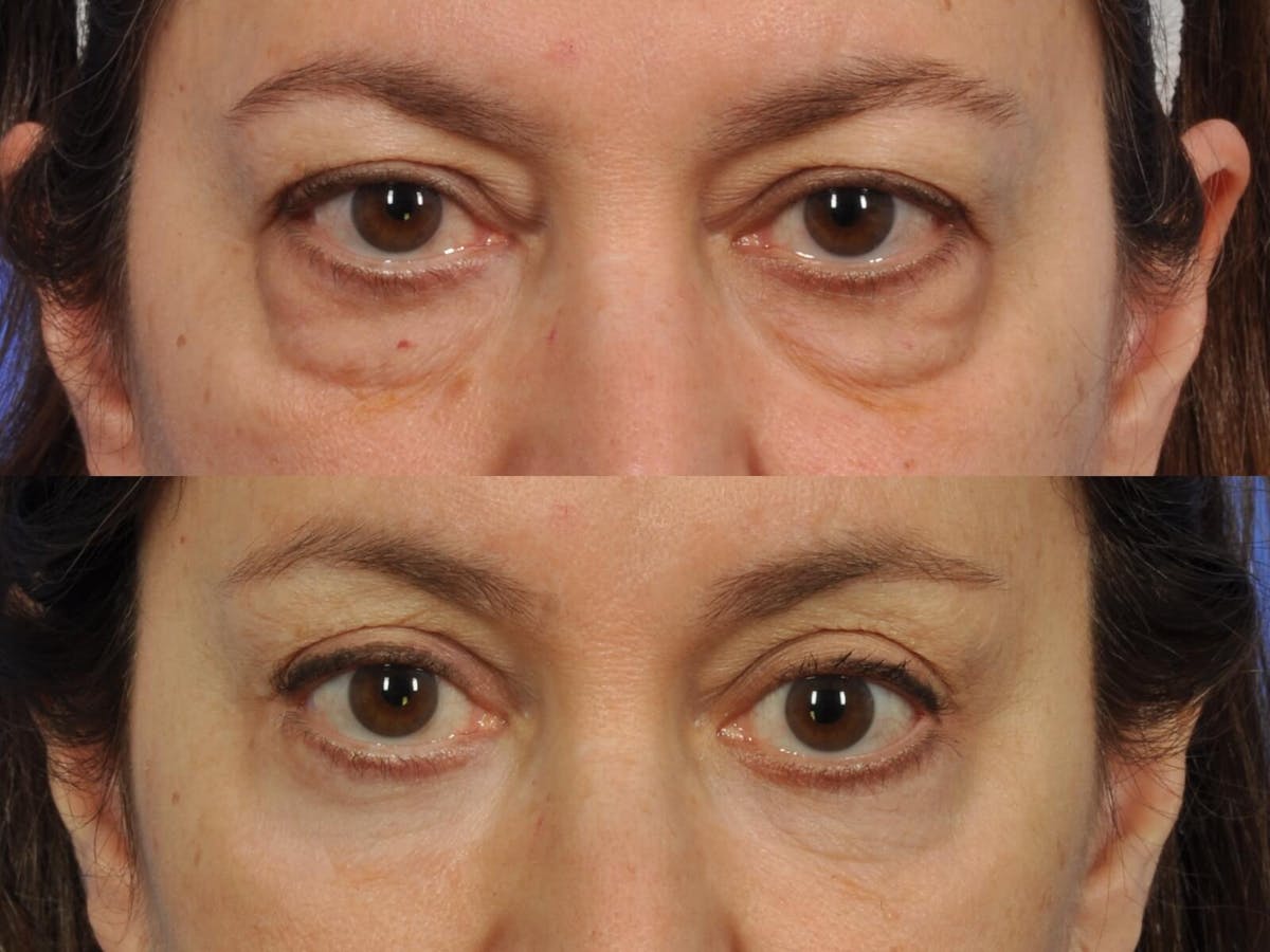 Brow Lift Before & After Gallery - Patient 136938 - Image 2