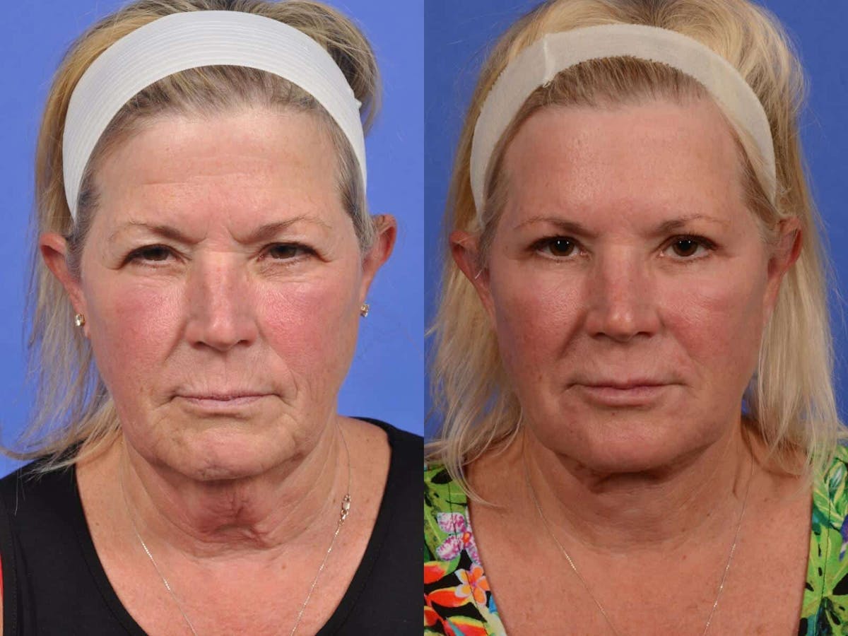 Brow Lift Before & After Gallery - Patient 733570 - Image 1