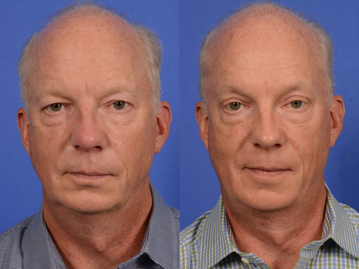 Brow Lift Before & After Gallery - Patient 136742 - Image 1
