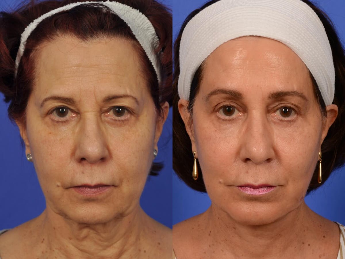 Brow Lift Before & After Gallery - Patient 577902 - Image 1