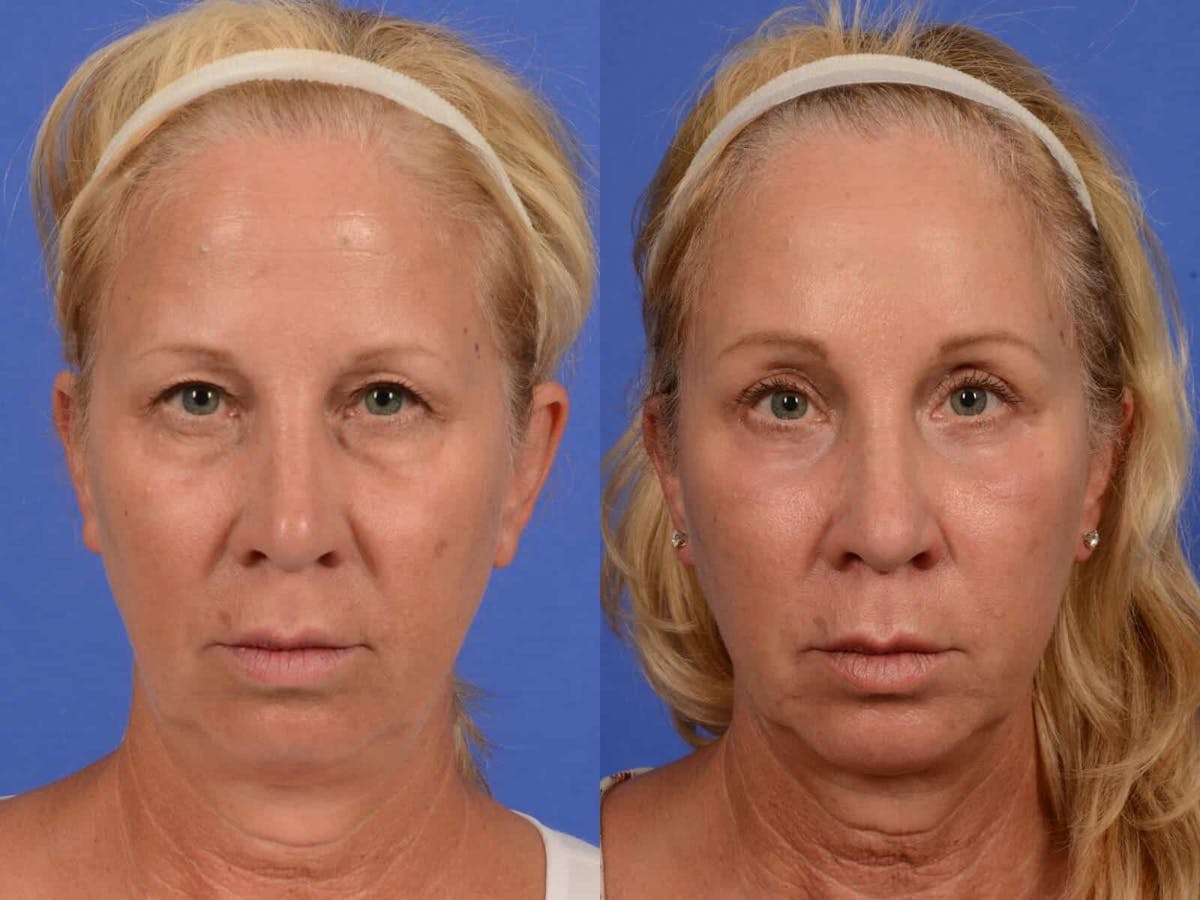 Brow Lift Before & After Gallery - Patient 331176 - Image 1