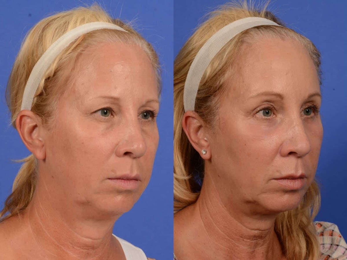 Brow Lift Before & After Gallery - Patient 331176 - Image 2