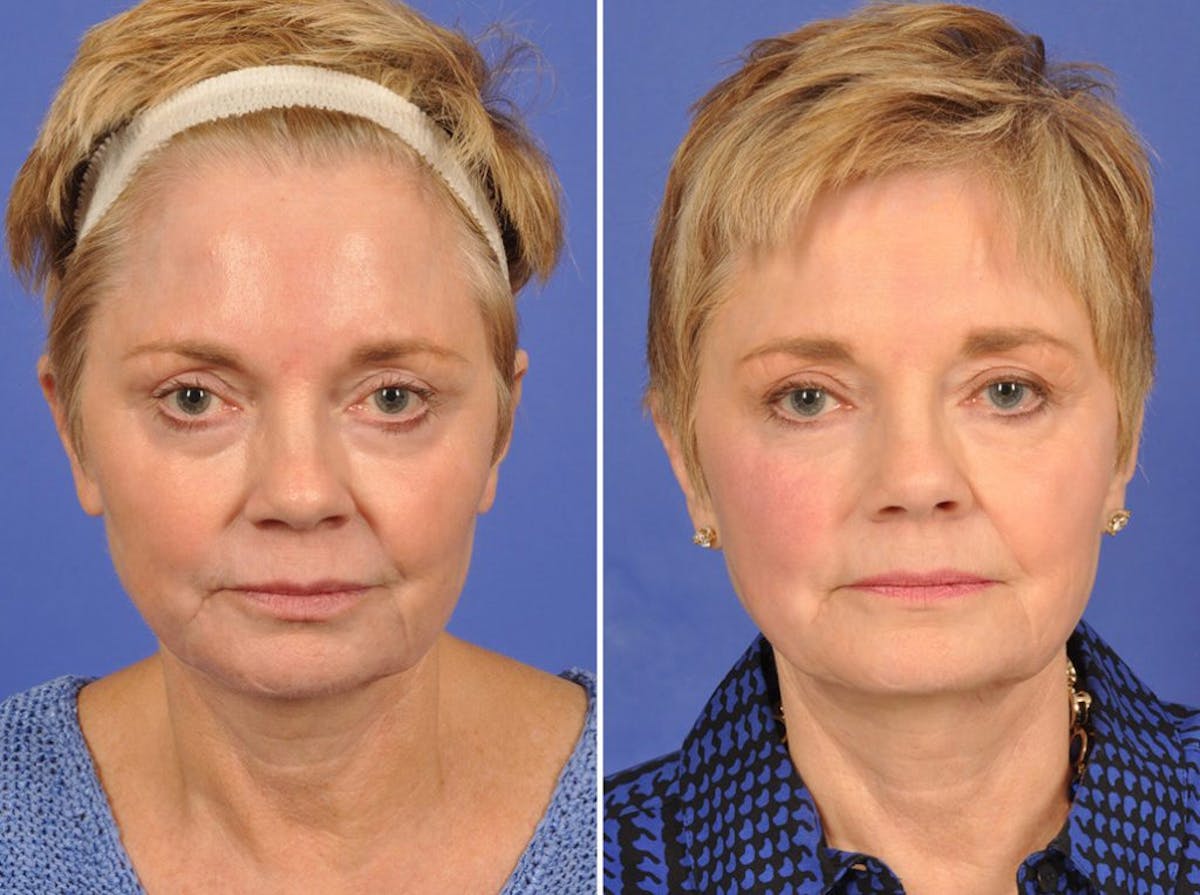 Brow Lift Before & After Gallery - Patient 337875 - Image 1