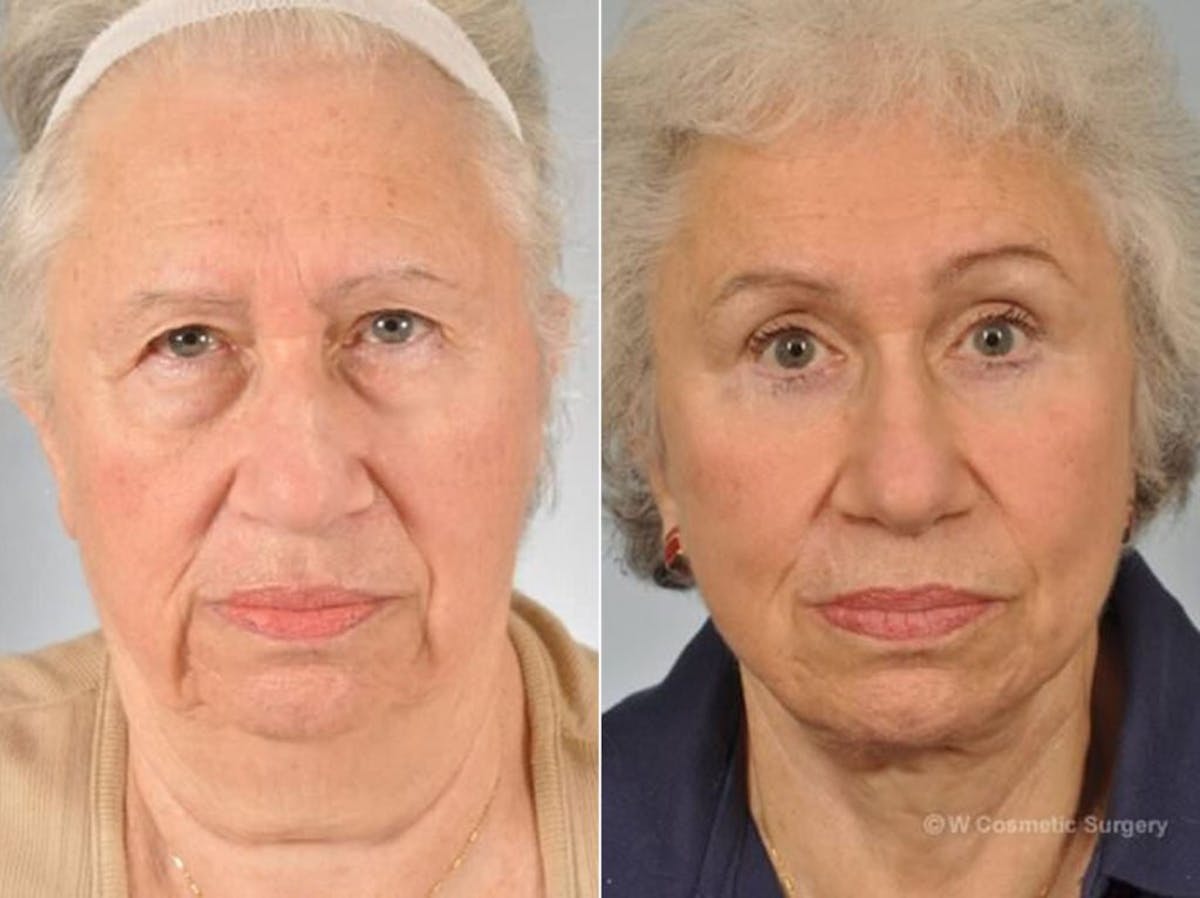 Brow Lift Before & After Gallery - Patient 406913 - Image 1
