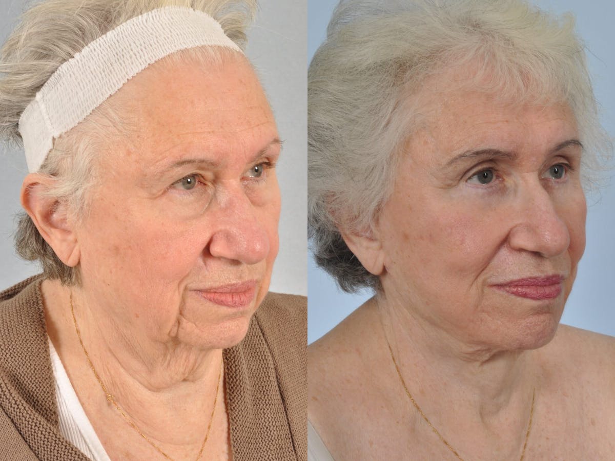 Brow Lift Before & After Gallery - Patient 406913 - Image 3