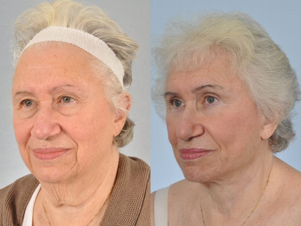 Brow Lift Before & After Gallery - Patient 406913 - Image 4