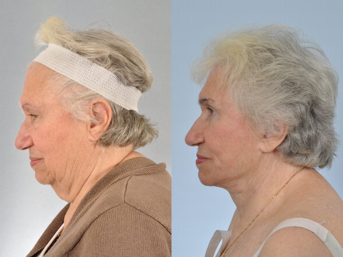Brow Lift Before & After Gallery - Patient 406913 - Image 6