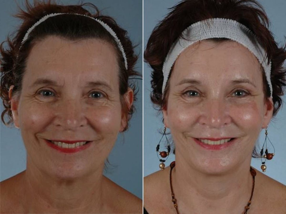 Brow Lift Before & After Gallery - Patient 118427 - Image 2