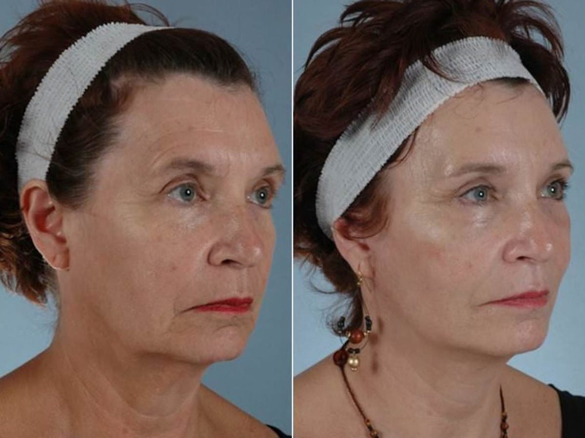 Brow Lift Before & After Gallery - Patient 118427 - Image 3