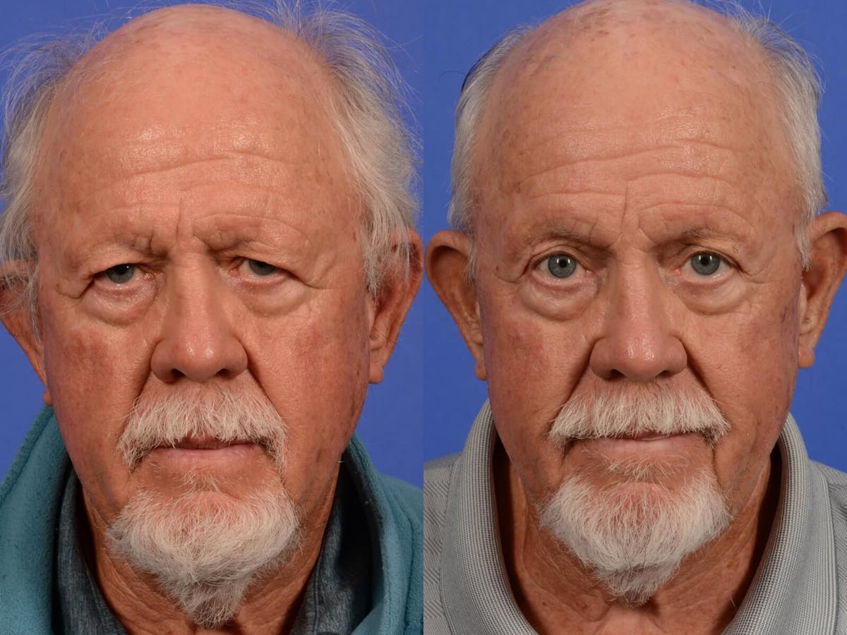 Brow Lift Before & After Gallery - Patient 276000 - Image 1