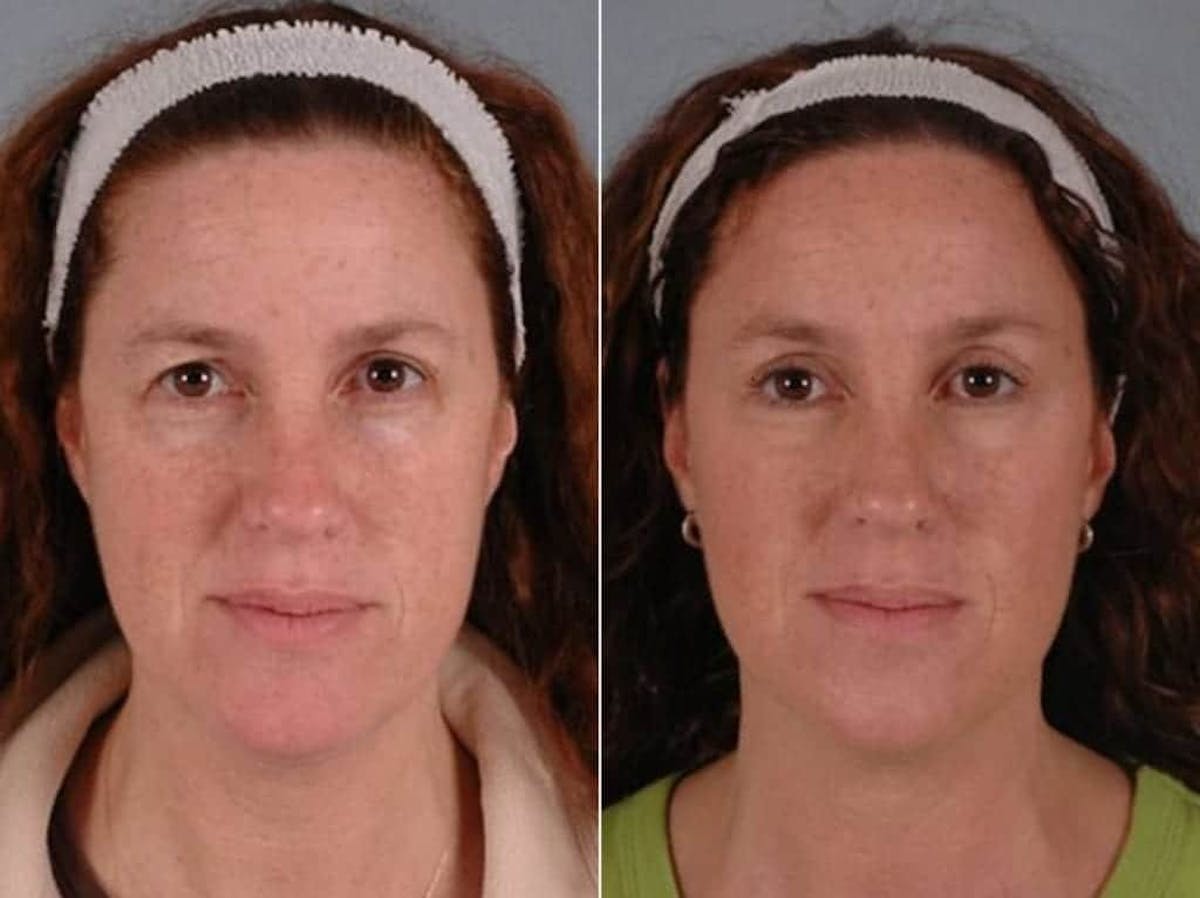 Brow Lift Before & After Gallery - Patient 394130 - Image 1