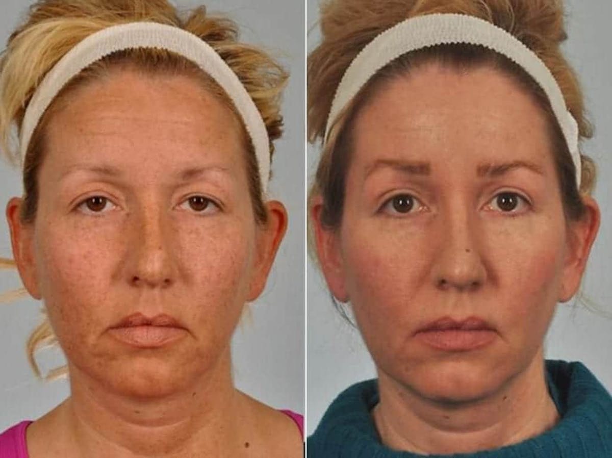 Brow Lift Before & After Gallery - Patient 240708 - Image 1
