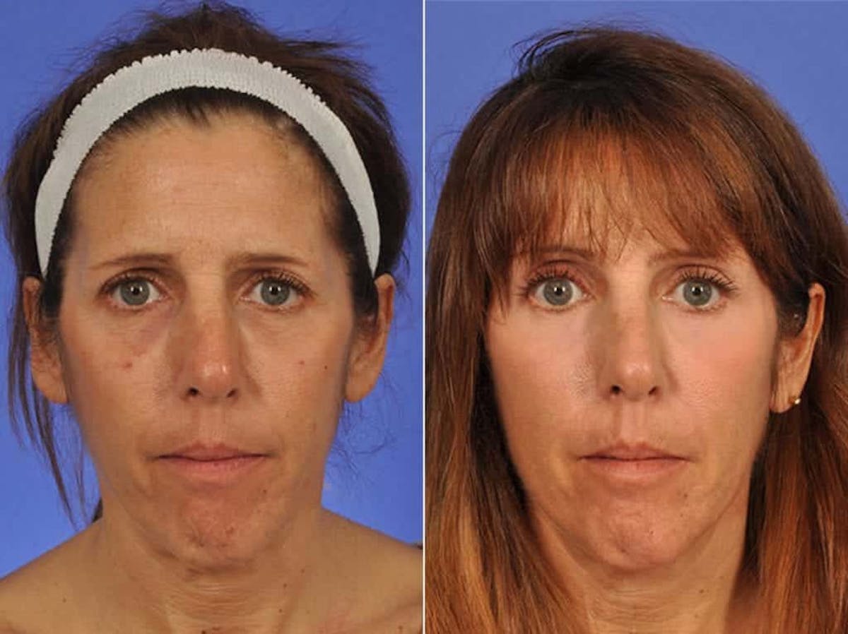 Brow Lift Before & After Gallery - Patient 320623 - Image 1