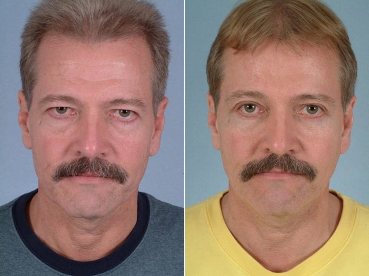 Brow Lift Before & After Gallery - Patient 637895 - Image 1
