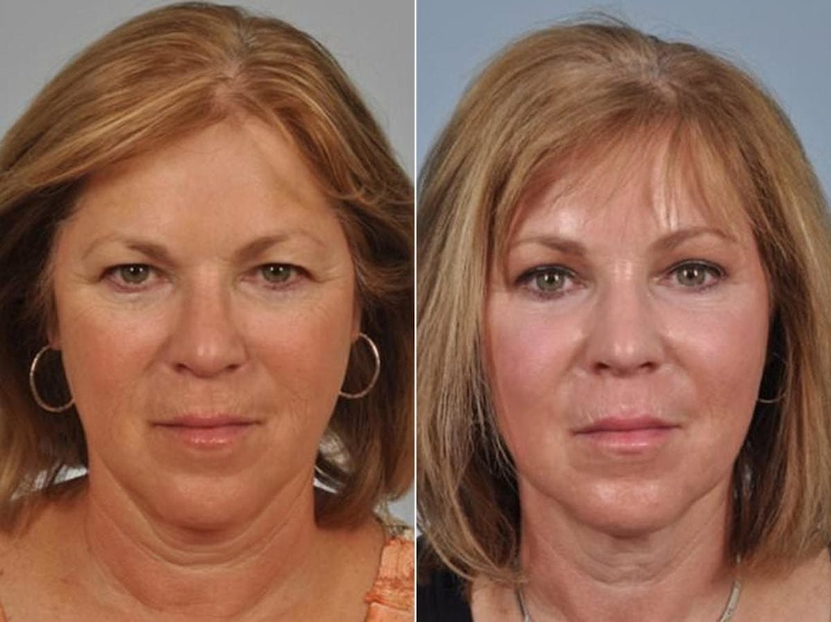 Brow Lift Before & After Gallery - Patient 211160 - Image 1