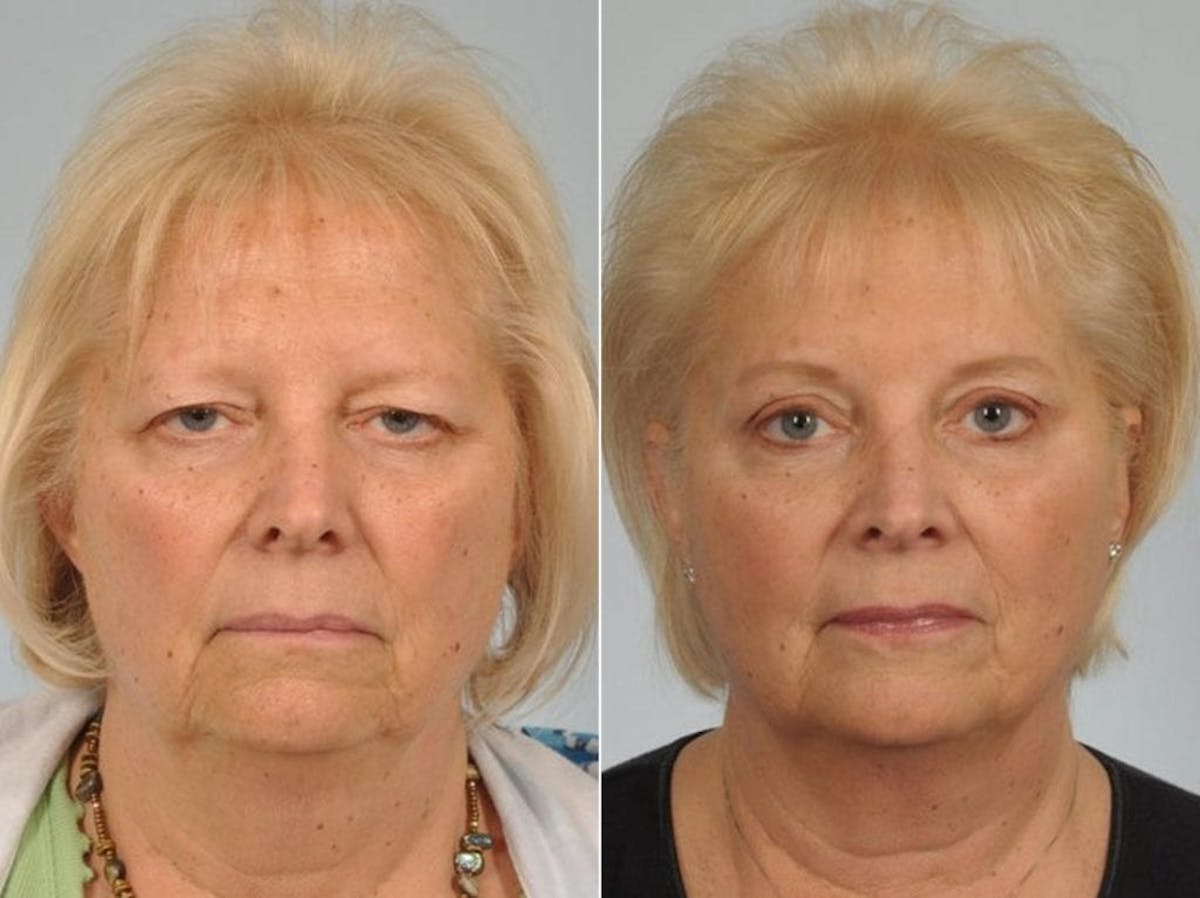 Brow Lift Before & After Gallery - Patient 186021 - Image 1