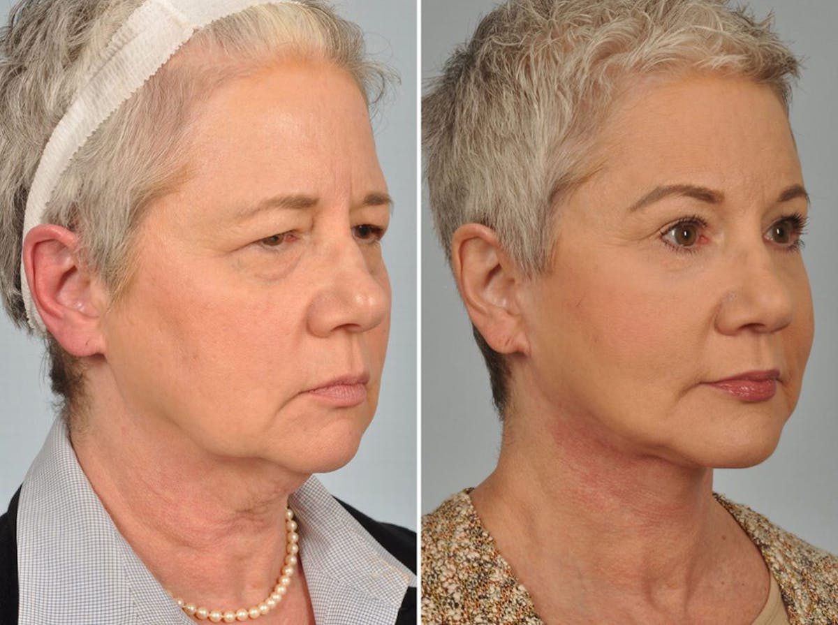 Brow Lift Before & After Gallery - Patient 857156 - Image 3