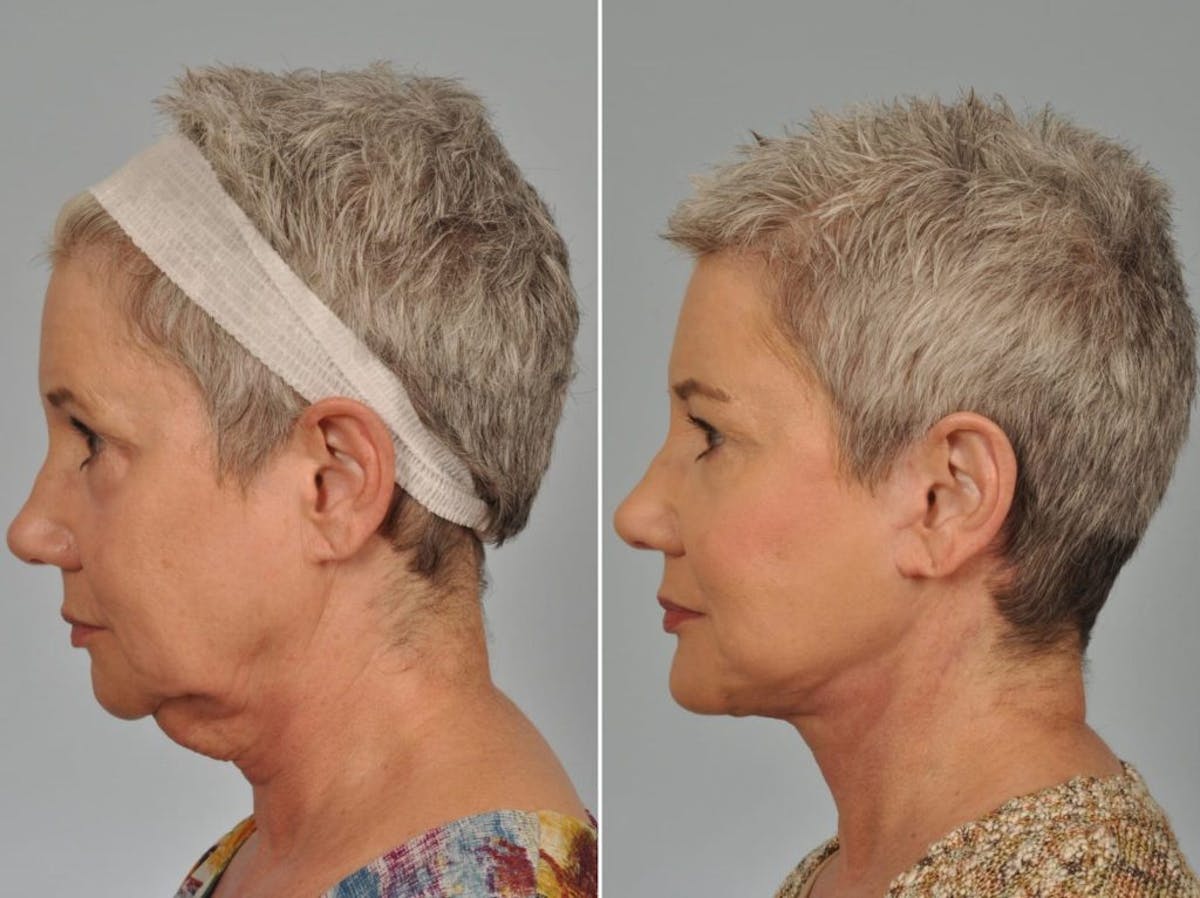 Brow Lift Before & After Gallery - Patient 857156 - Image 4