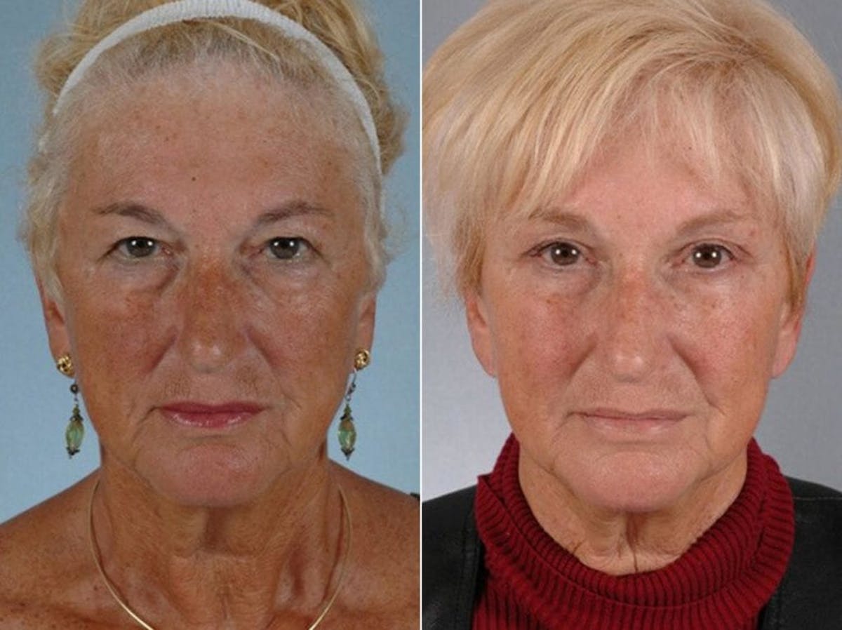 Brow Lift Before & After Gallery - Patient 418562 - Image 1