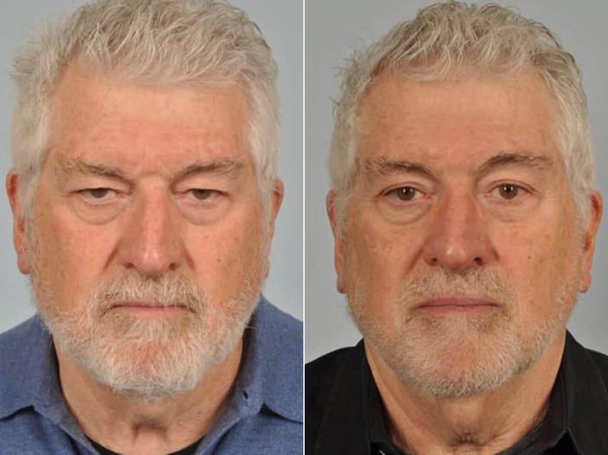 Brow Lift Before & After Gallery - Patient 369262 - Image 1