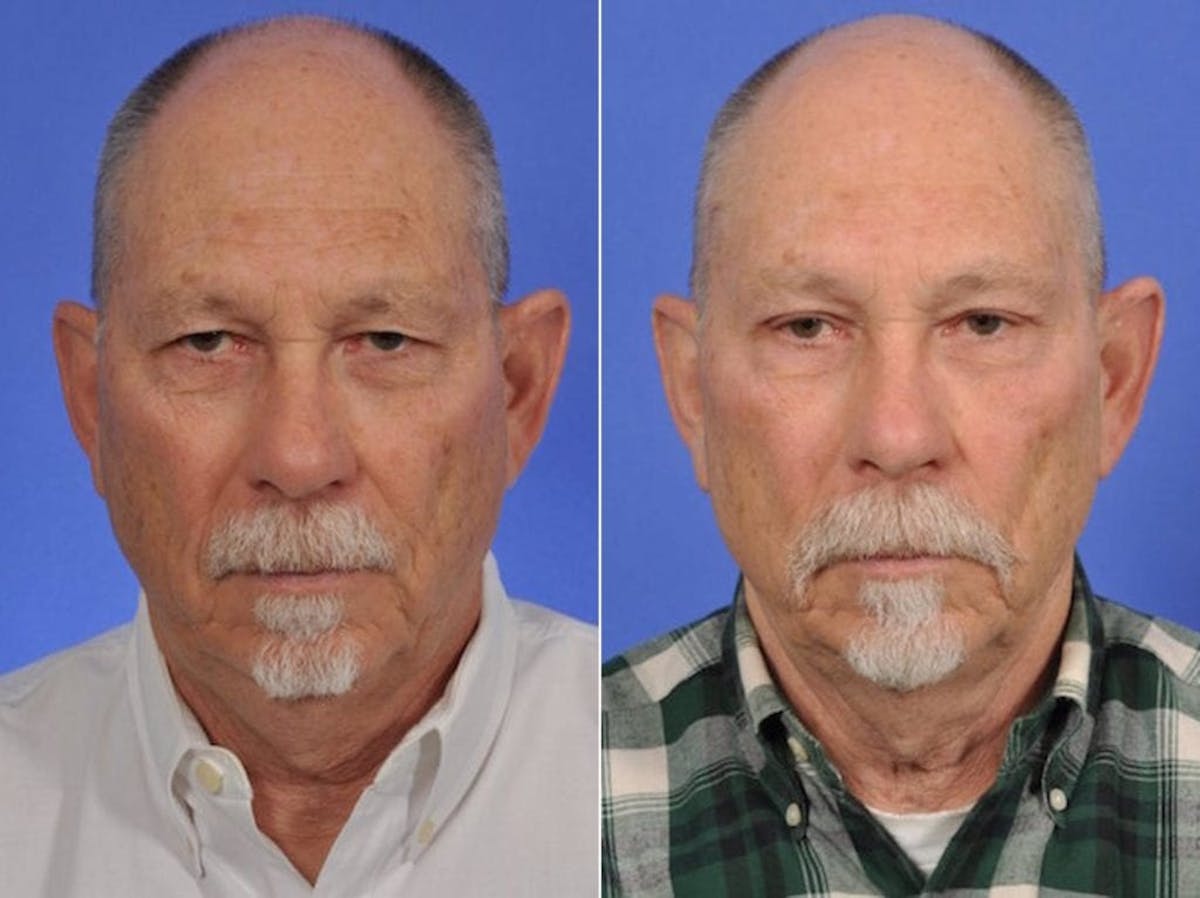 Brow Lift Before & After Gallery - Patient 324716 - Image 1