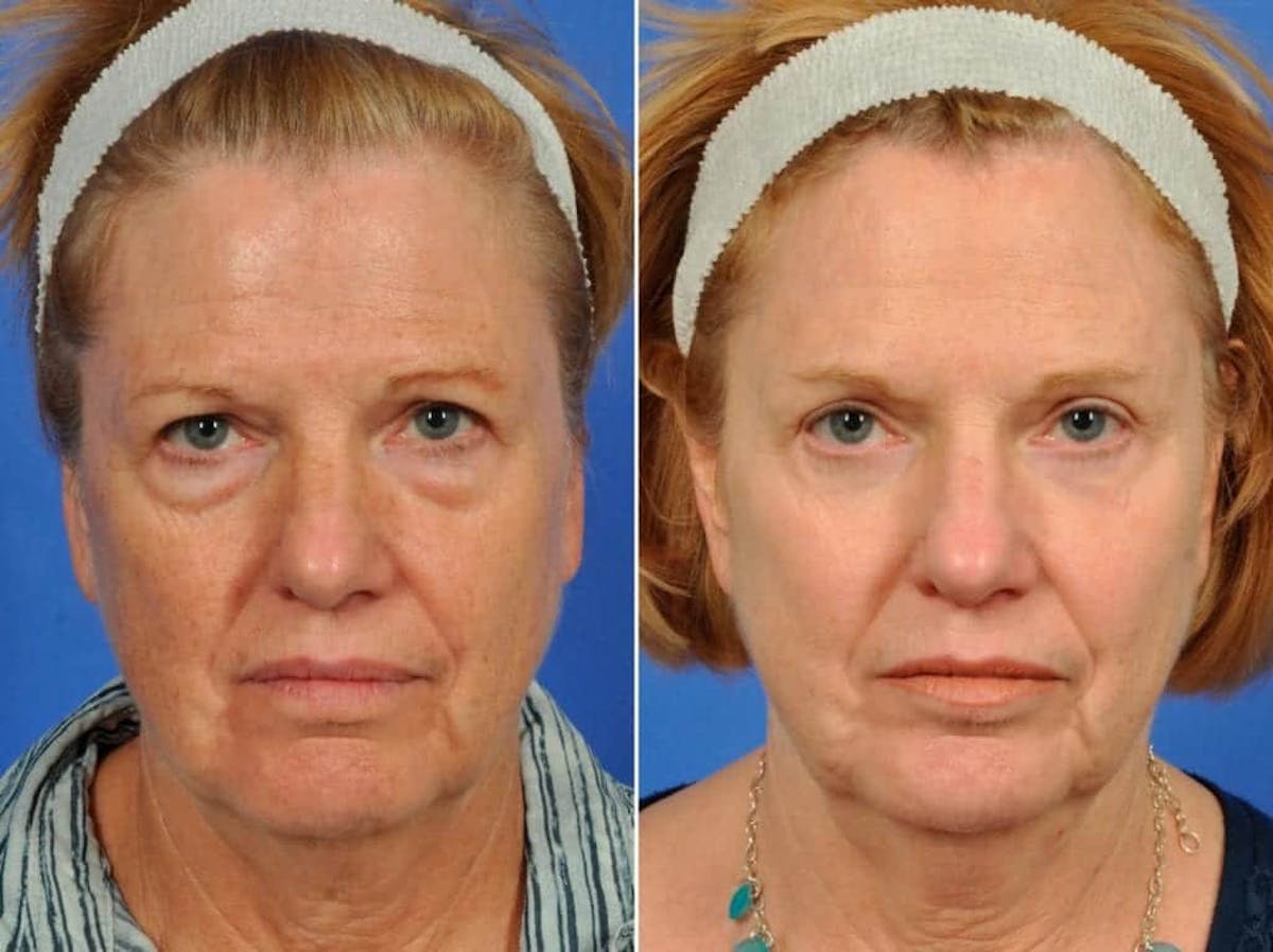 Brow Lift Before & After Gallery - Patient 714526 - Image 1