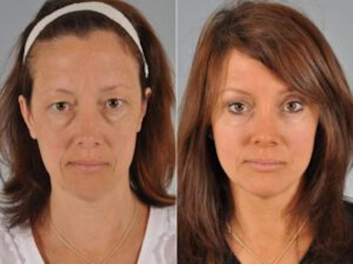 Brow Lift Before & After Gallery - Patient 187455 - Image 1