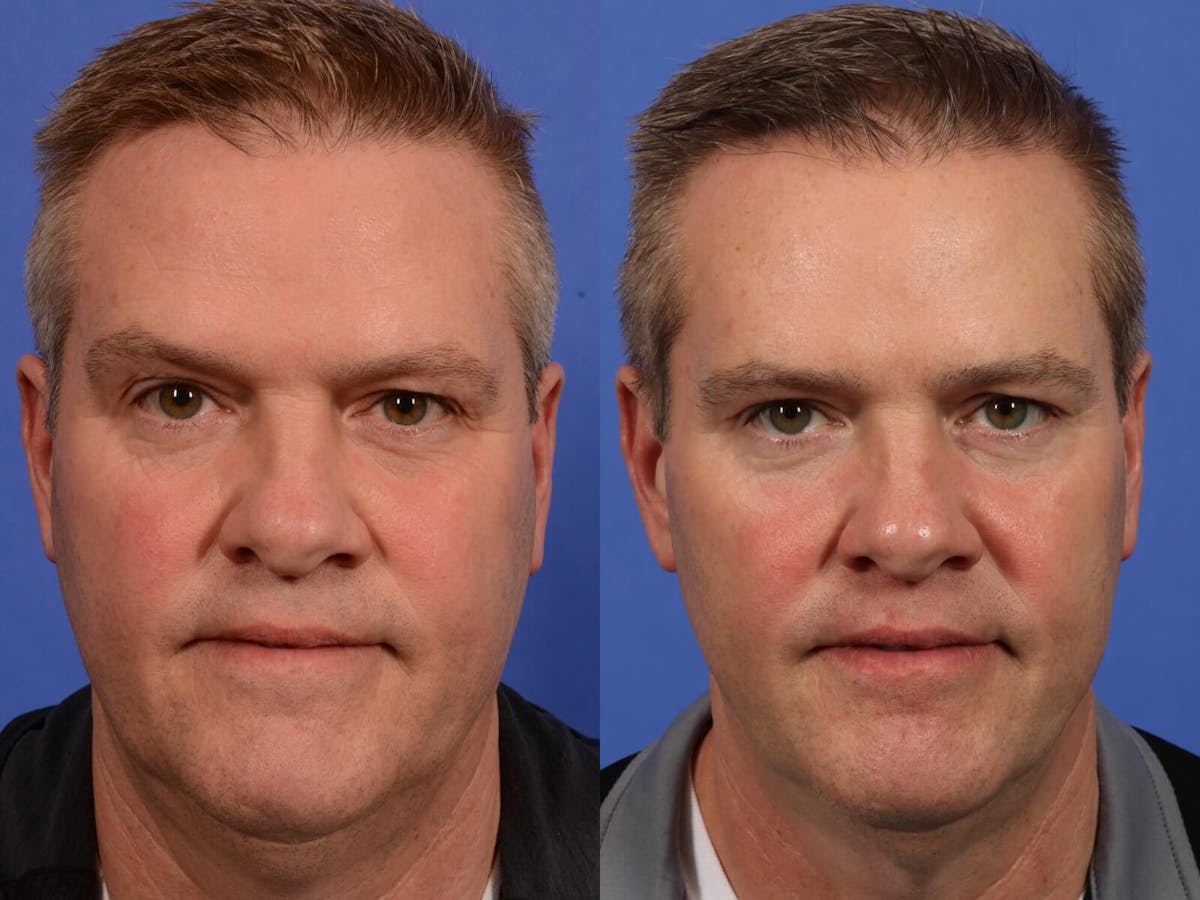 Brow Lift Before & After Gallery - Patient 198008 - Image 1