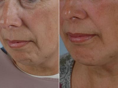 Chin Implant Before & After Gallery - Patient 336151 - Image 1