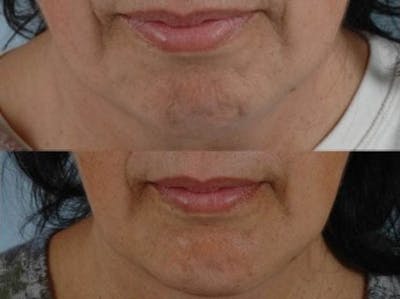 Chin Implant Before & After Gallery - Patient 336151 - Image 2