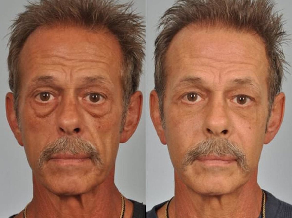 Chin Implant Before & After Gallery - Patient 160241 - Image 1