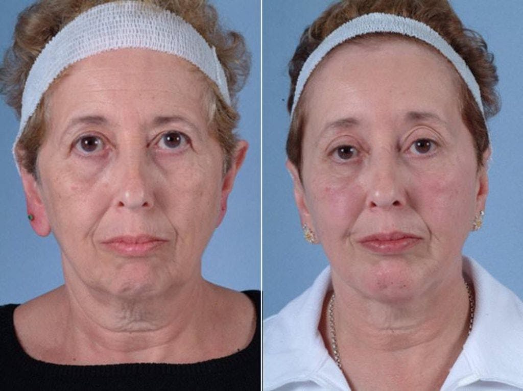 Chin Implant Before & After Gallery - Patient 419315 - Image 1