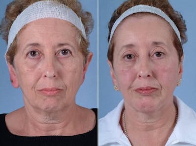 Chin Implant Before & After Gallery - Patient 419315 - Image 1