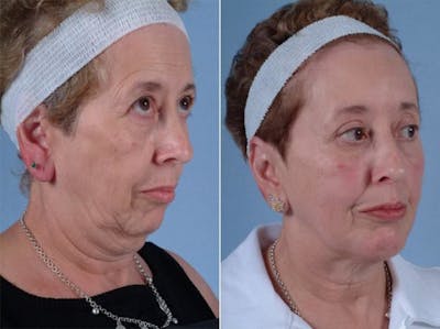 Chin Implant Before & After Gallery - Patient 419315 - Image 2