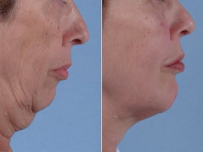 Chin Implant Before & After Gallery - Patient 419315 - Image 4