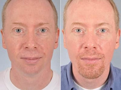 Chin Implant Before & After Gallery - Patient 684309 - Image 1